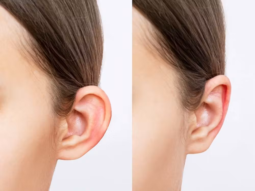 Otoplasty Turkey surgical planning at leading otoplasty Istanbul clinic performed by best otoplasty Turkey specialists