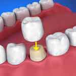 COURONNE EN PORCELAINE