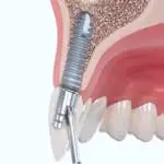 IMPLANT MEDENTIKA