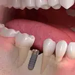 IMPLANT STRAUMANN