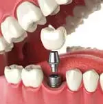 IMPLANT ZINEDENT