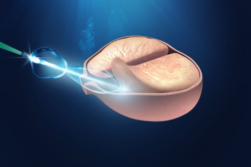 HoLEP Istanbul – HoLEP Surgery in Turkey – HoLEP Cost Turkey – Best HoLEP Surgery Turkey – HoLEP Procedure Turkey